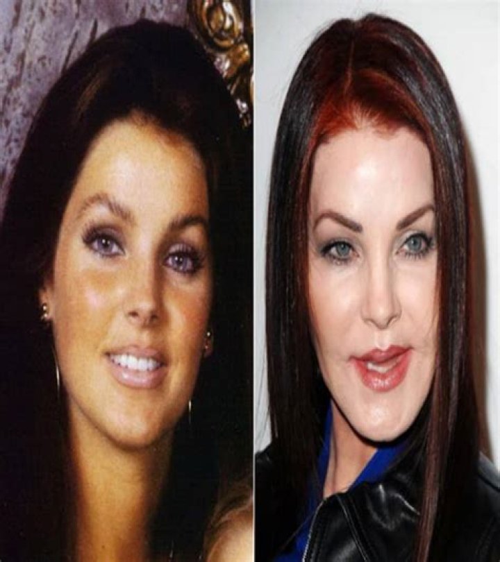 20 Celebrity BeforeAndAfter Plastic Surgery Disasters Page 10