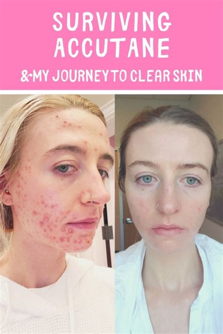 9 Month Accutane Transformation Before & After Photos &mdash; Crystal Clear