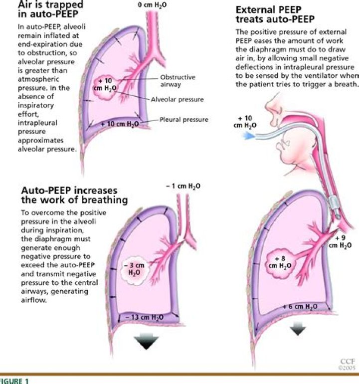 Autopositive endexpiratory pressure mechanisms and treatment