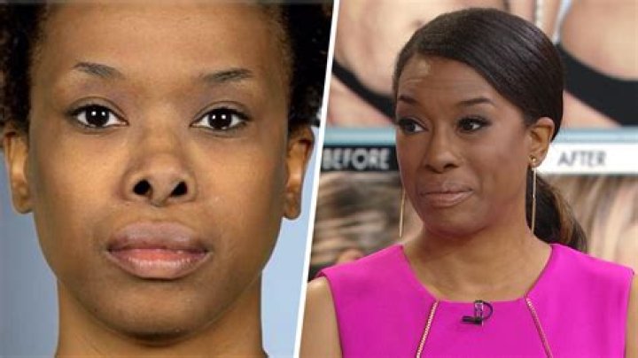 Botched nose job leaves woman with implant sticking out between her EYES