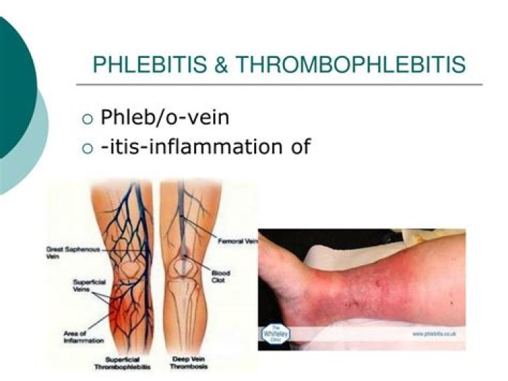 Difference Between Phlebitis and Thrombophlebitis Turner Syndrome