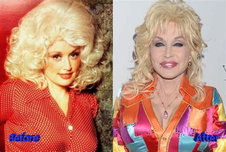 Dolly Parton Plastic Surgery Before and After Breast Implants, Facelift