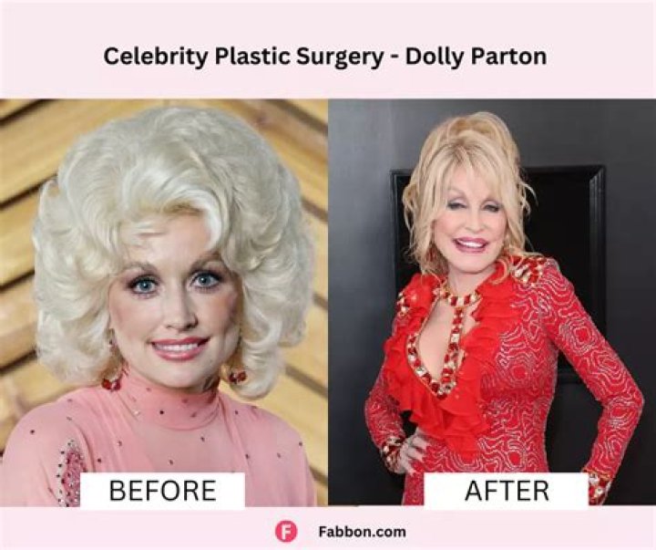 Dolly Parton Plastic Surgery What Has She Gotten Done?