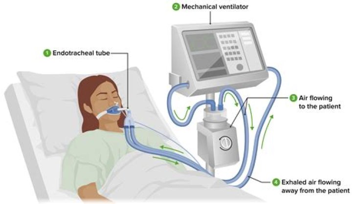 Final Considerations in Ventilator Setup Thoracic Key