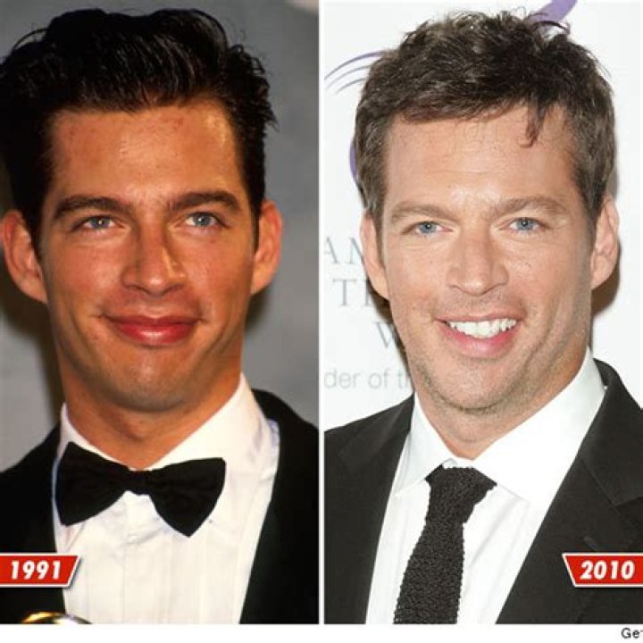 Harry Connick Jr. Stroke: Symptoms, Timeline, And Recovery