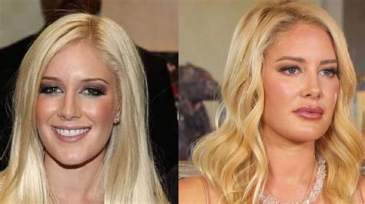 Heidi Montag Plastic Surgery Before And After Pics