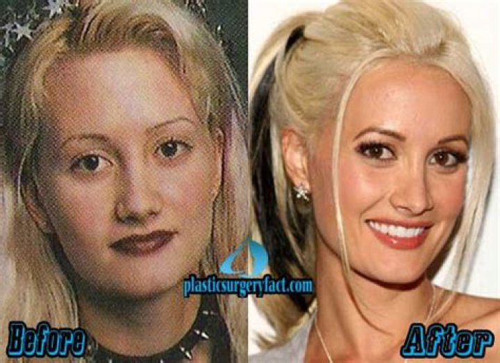 Holly Madison Plastic Surgery Before and After Look Photos