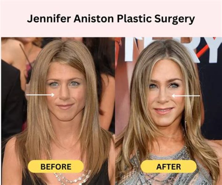 Jennifer Aniston Plastic Surgery Nose Job, Boob Job, Botox