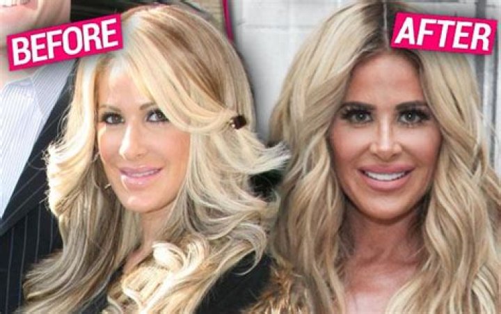 Kim ZolciakBiermann Plastic Surgery Claims Exposed By Top Docs