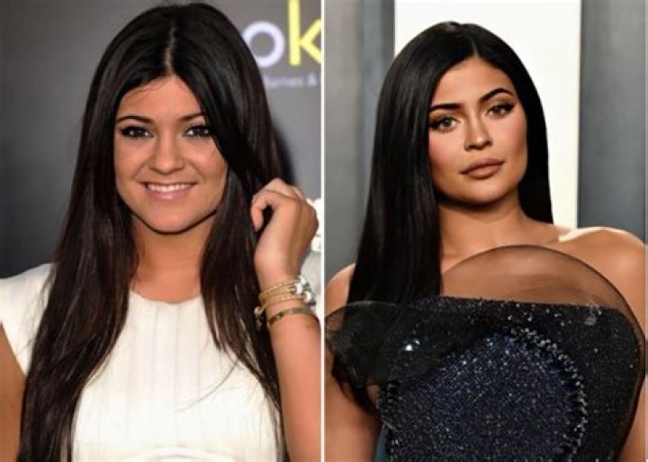 Kylie Jenner Before and After Plastic Surgery Photos Reveal Drastic
