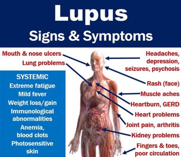 Lupus Causes, symptoms, and research