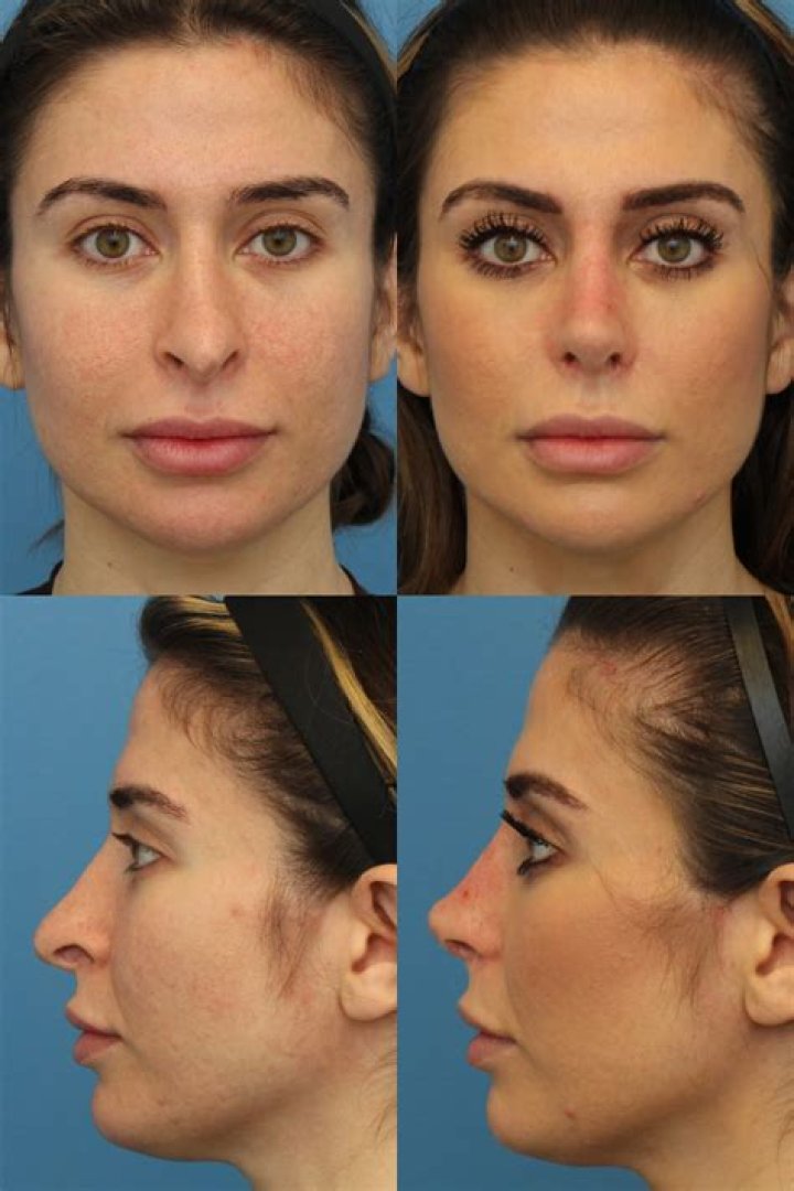 Rhinoplasty, Lip Filler, Cheek Implants (Bad Bunny) Rhinoplasty, Lip