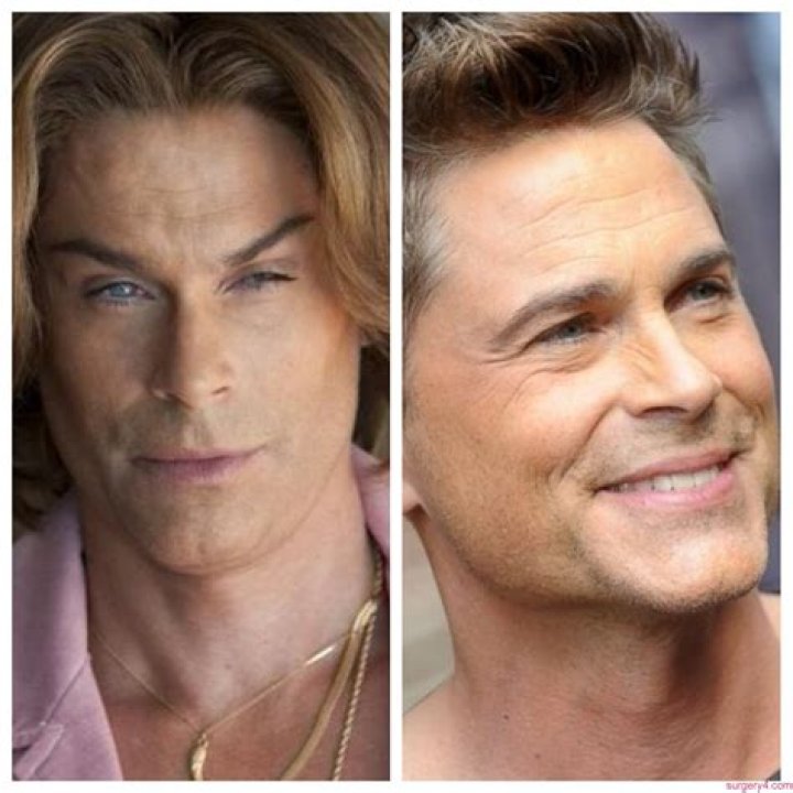 Rob Lowe before and after plastic surgery (3) Celebrity plastic