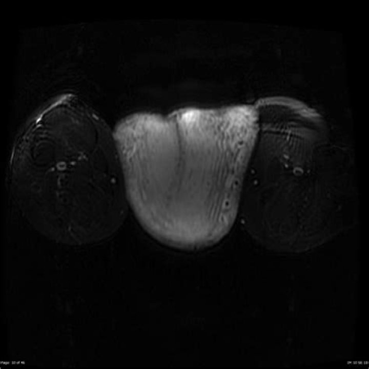 Scrotal Lymphedema