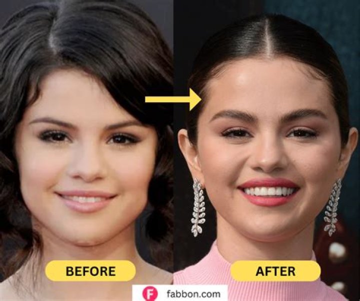 Selena Gomez Plastic Surgery Boobs (breast enhancement), Face