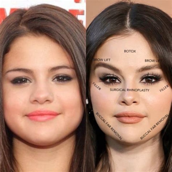 Selena Gomez plastic surgery ?!?!?! Selenators Amino