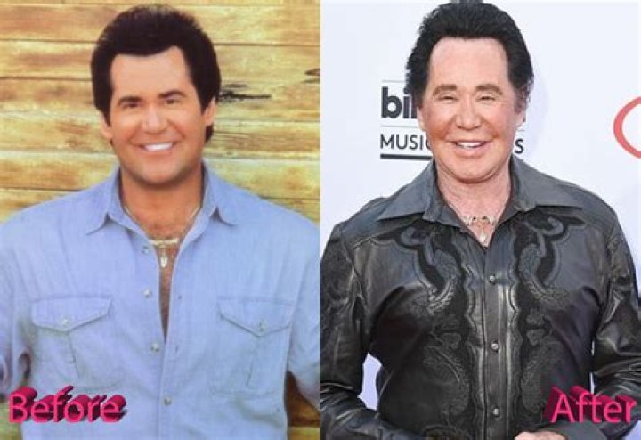 Wayne Newton Plastic Surgery, Weight Loss, Illness, And Health Update.