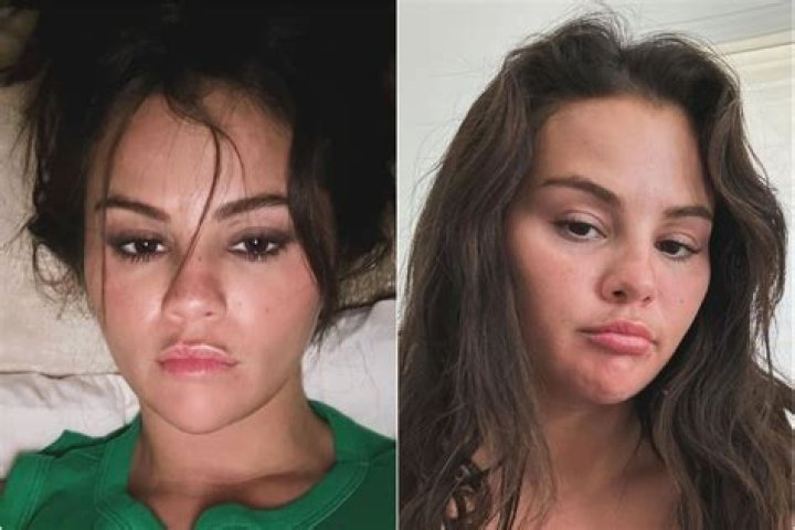 What Happened To Selena Gomez Face